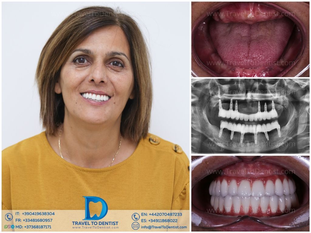 Caso clínico 5 – Resultado dental